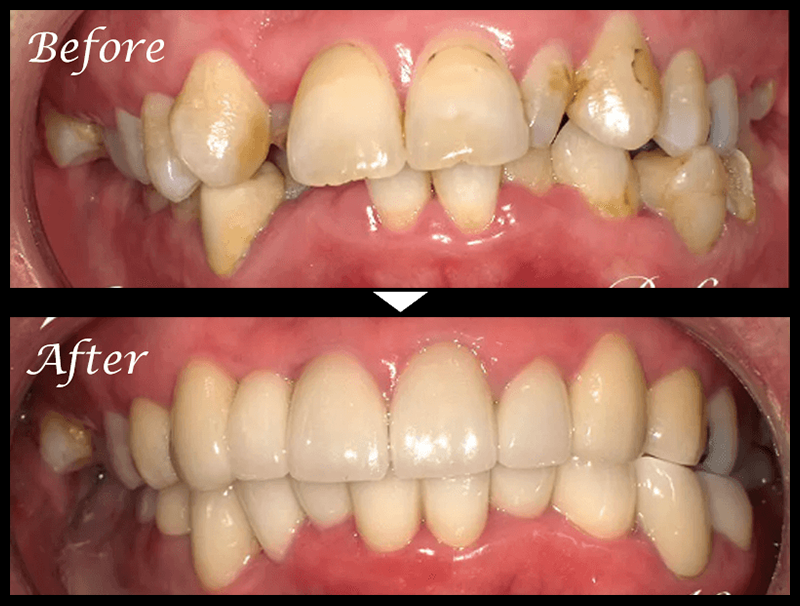 セラミック治療症例