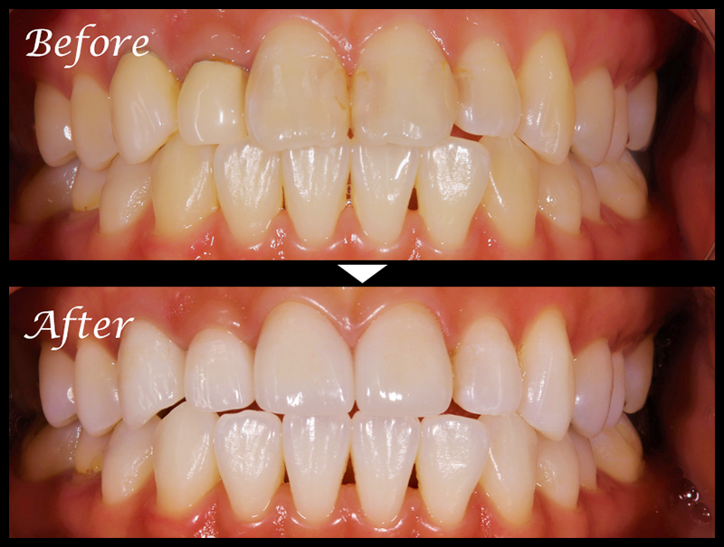 セラミック治療症例