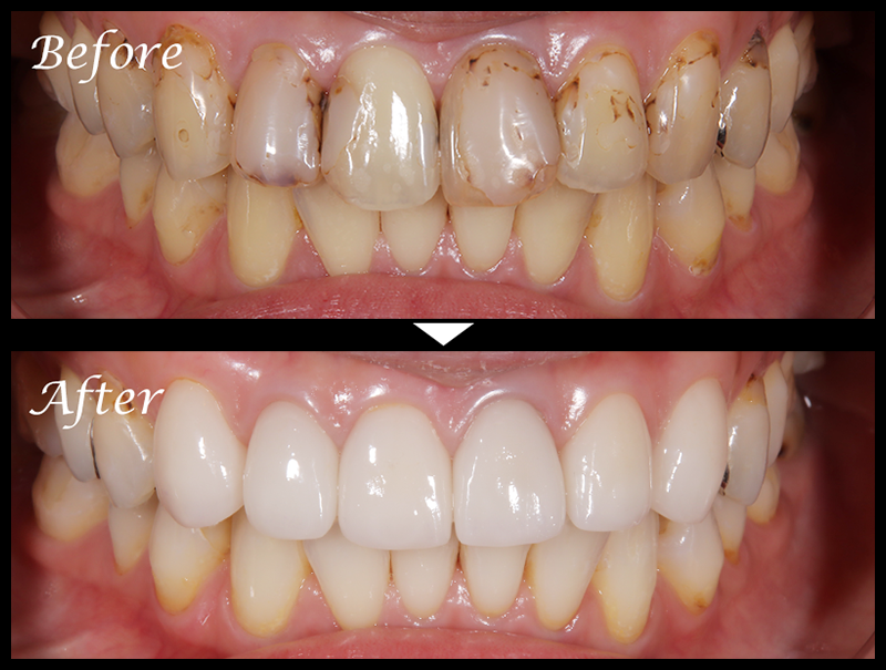 セラミック治療症例