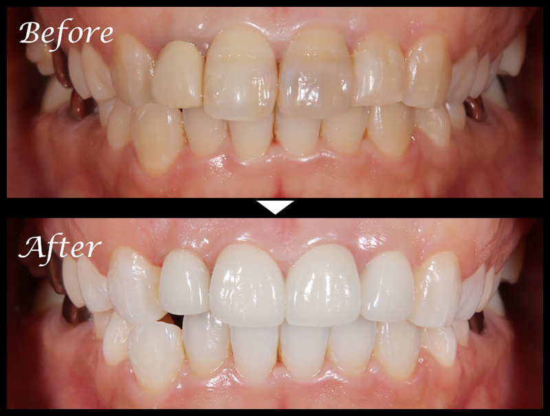 セラミック治療症例