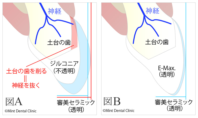 E-Maxとジルコニアの比較